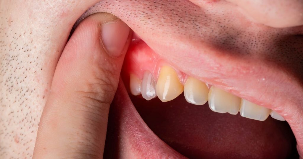 encías inflamadas