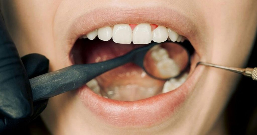 gingivitis grandental