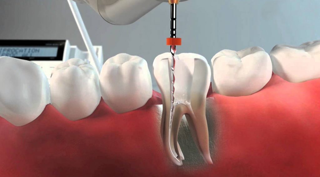 tratamiento endodoncia