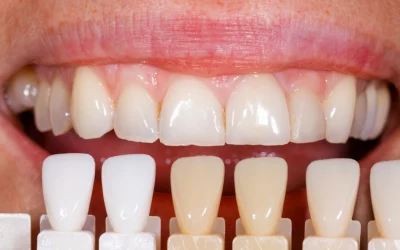 Carillas dentales en Fuenlabrada