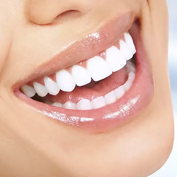 Blanqueamiento dental en Fuenlabrada