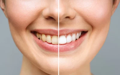 Blanqueamiento dental en Móstoles: guía completa para una sonrisa perfecta