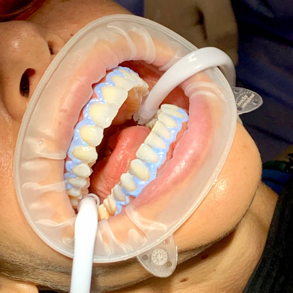 blanqueamiento dental en Móstoles