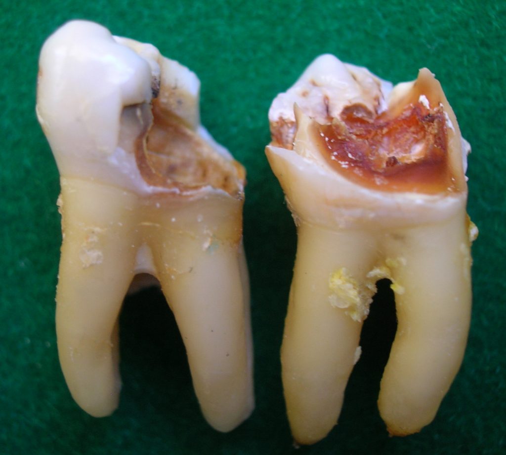 detectar caries a tiempo
