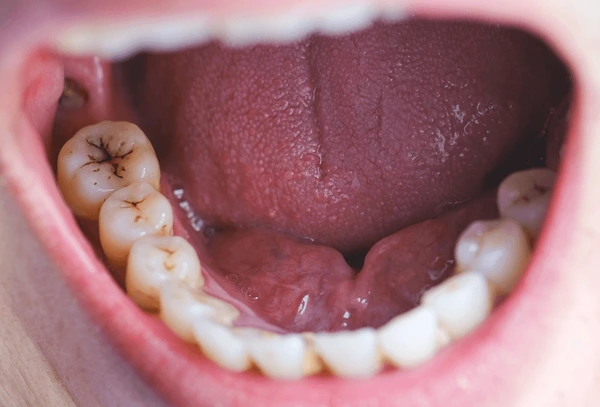 detectar caries a tiempo