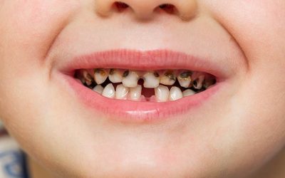 Cómo evitar las caries en niños
