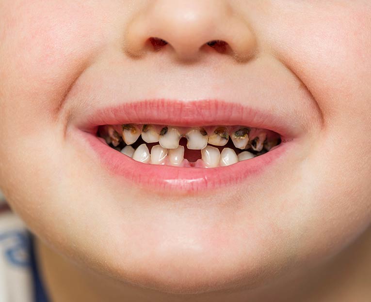 caries en niños