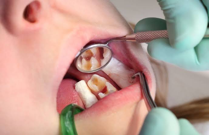 caries en niños
