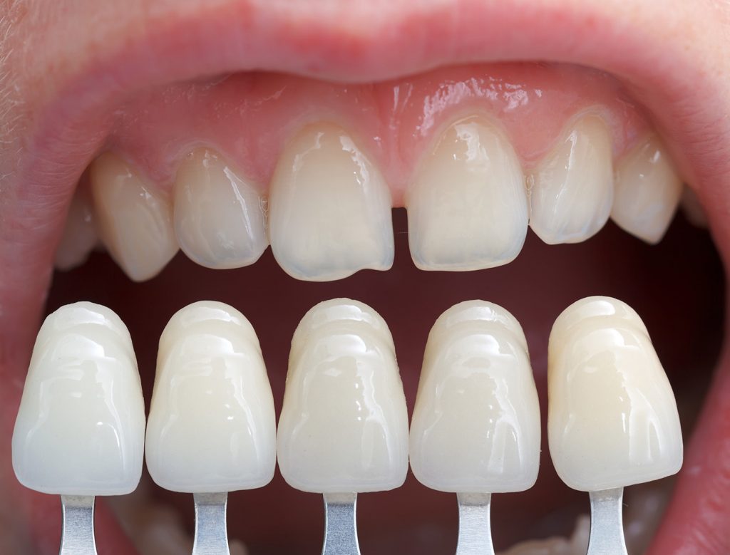 Diferencias entre carillas de composite y porcelana