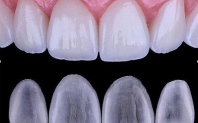 Carillas dentales en Móstoles