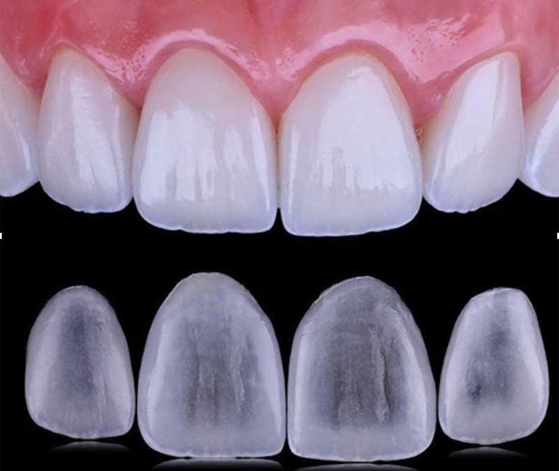 Carillas dentales en Móstoles: