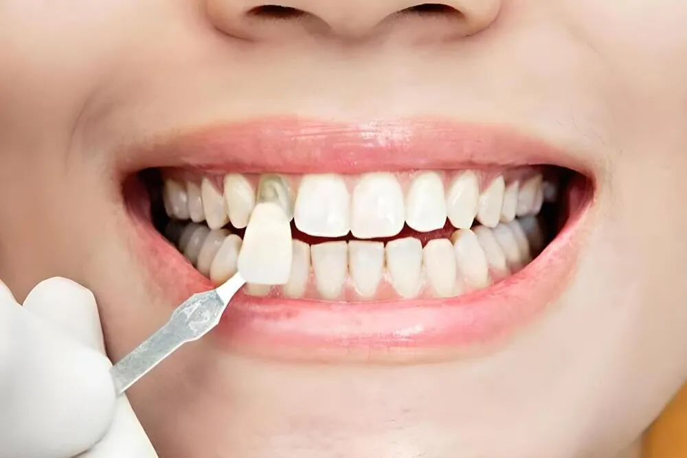 Carillas dentales en Móstoles