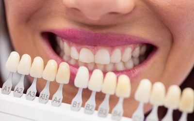 Diferencias entre carillas de composite y porcelana: guía completa para tu sonrisa