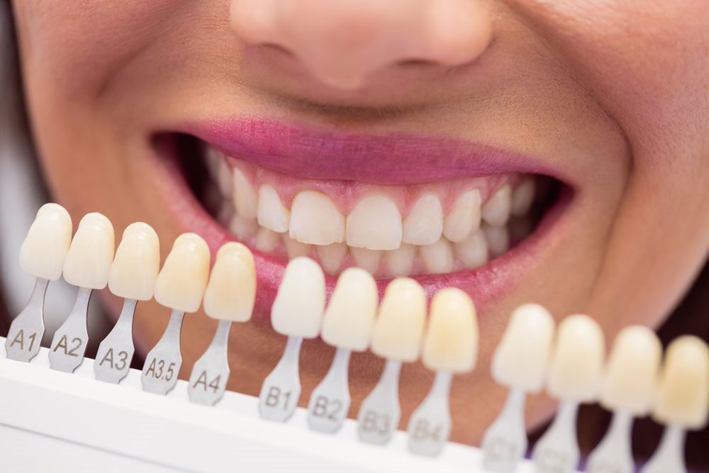 Diferencias entre carillas de composite y porcelana