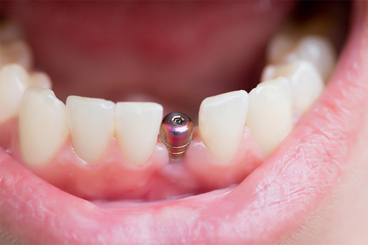 Cuánto duran los implantes dentales