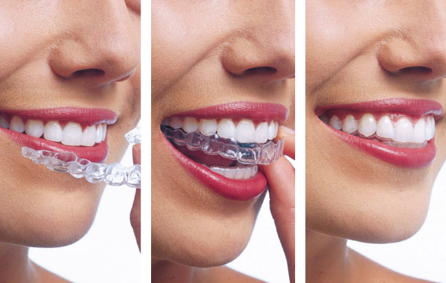 Invisalign en Fuenlabrada