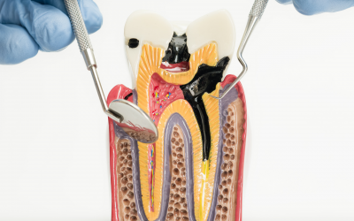 Cómo prevenir caries