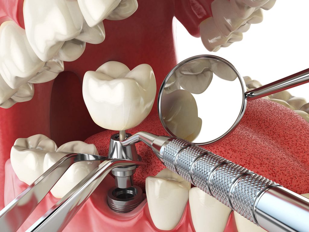 Implantes dentales en Fuenlabrada