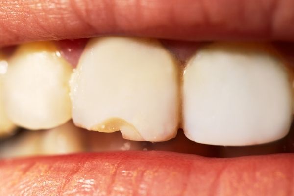 Qué hacer si se rompe un diente