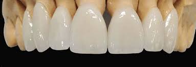 Dientes de porcelana o circonio