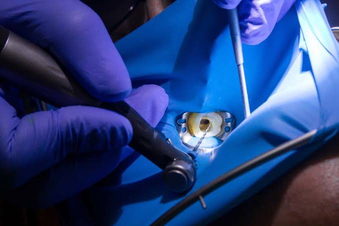 cuándo es necesaria una endodoncia