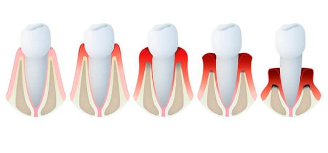 gingivitis grandental