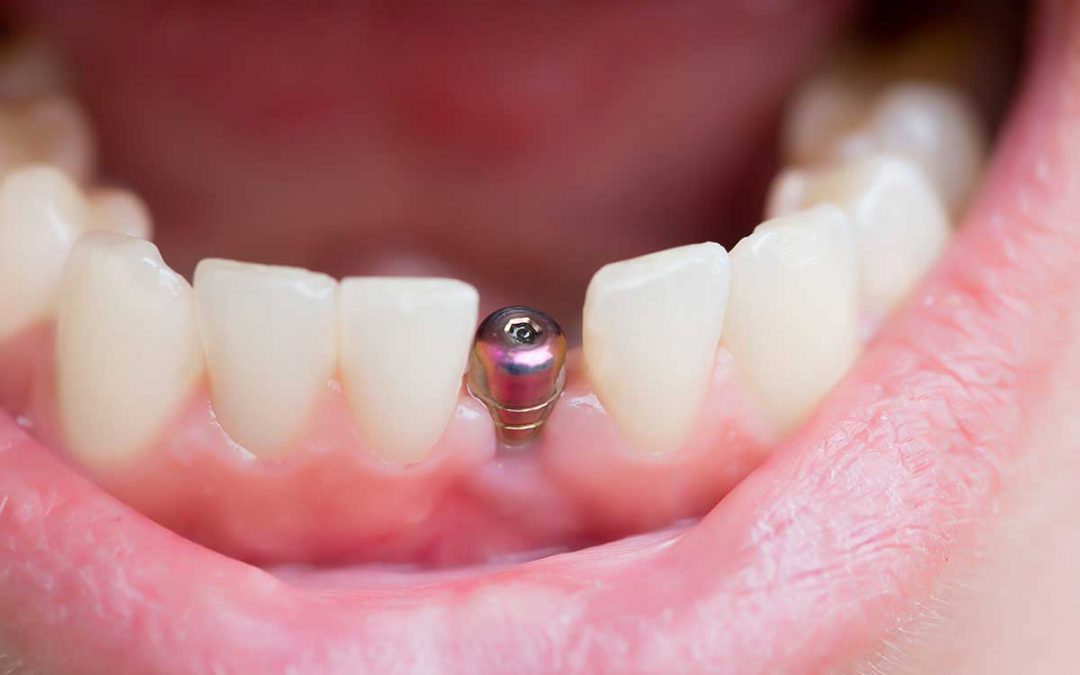 Implantes dentales en Fuenlabrada