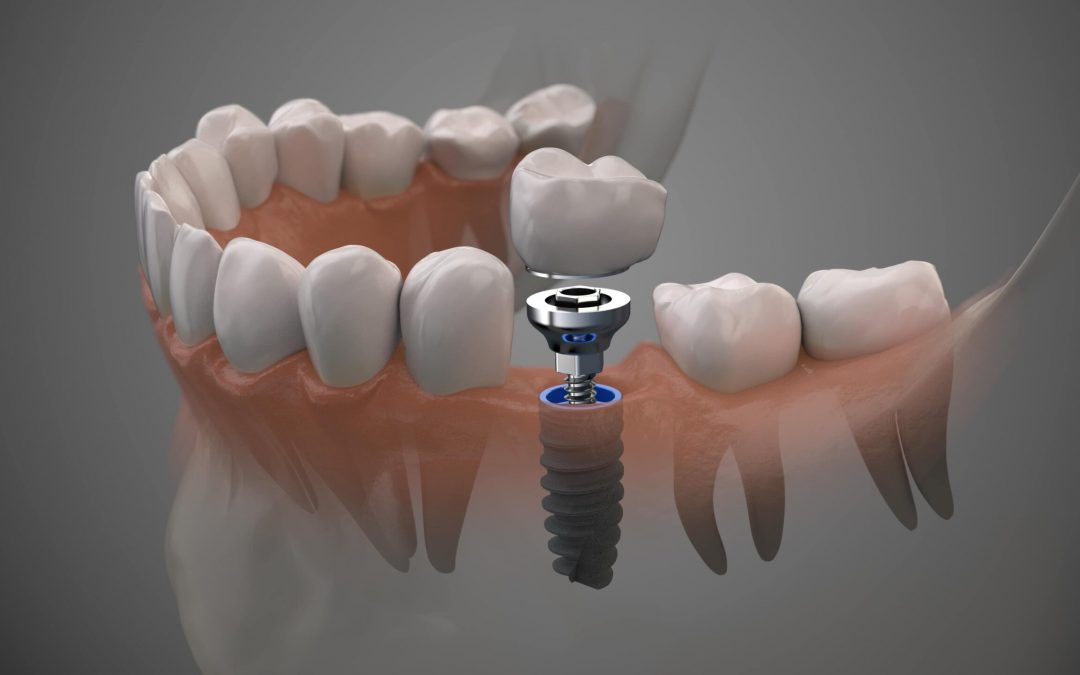 Implantes dentales en Móstoles