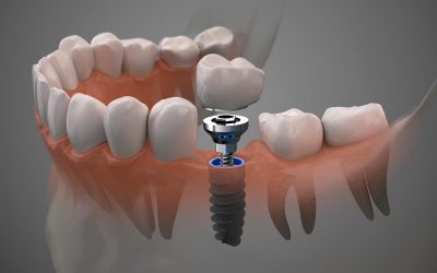 Cuánto duran los implantes dentales