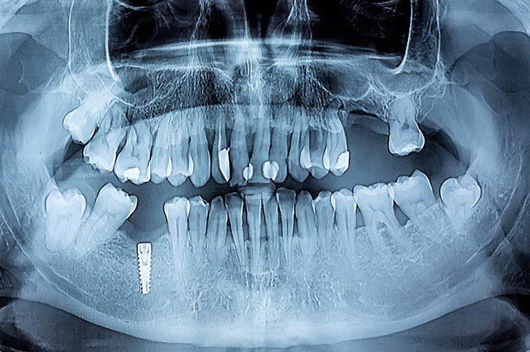 implantes dentales en móstoles
