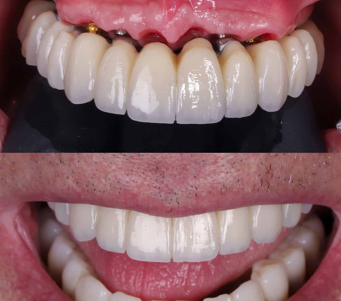 implantes dentales en móstoles