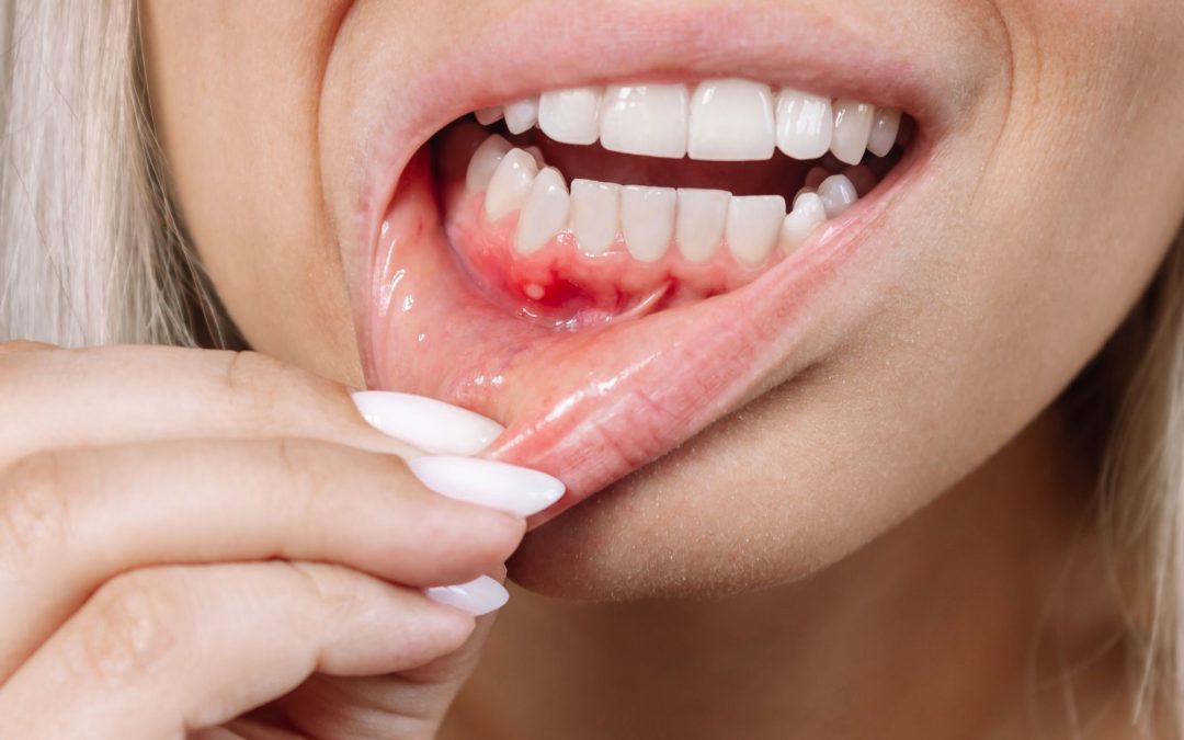 infección dental