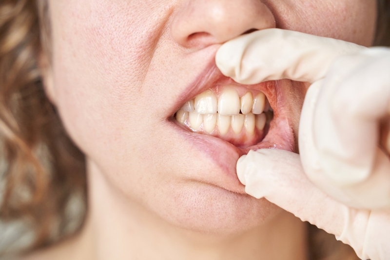 infección dental