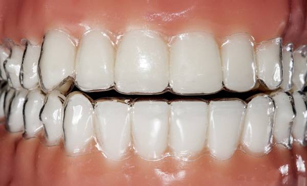 tratamiento Invisalign mostoles