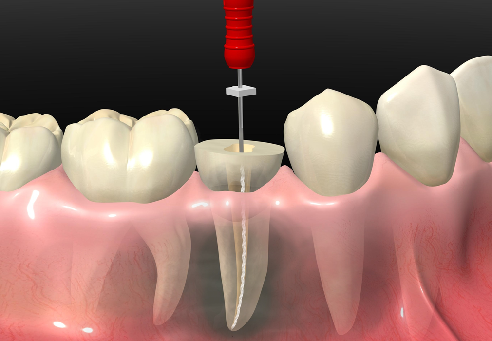 Cuándo es necesario una endodoncia