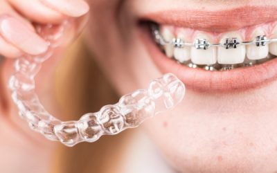 Ortodoncia en Móstoles: opciones, cómo elegir y qué esperar del tratamiento