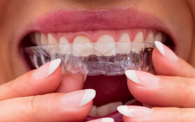 Ortodoncia invisible en Fuenlabrada