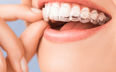 Alineadores invisibles en Fuenlabrada