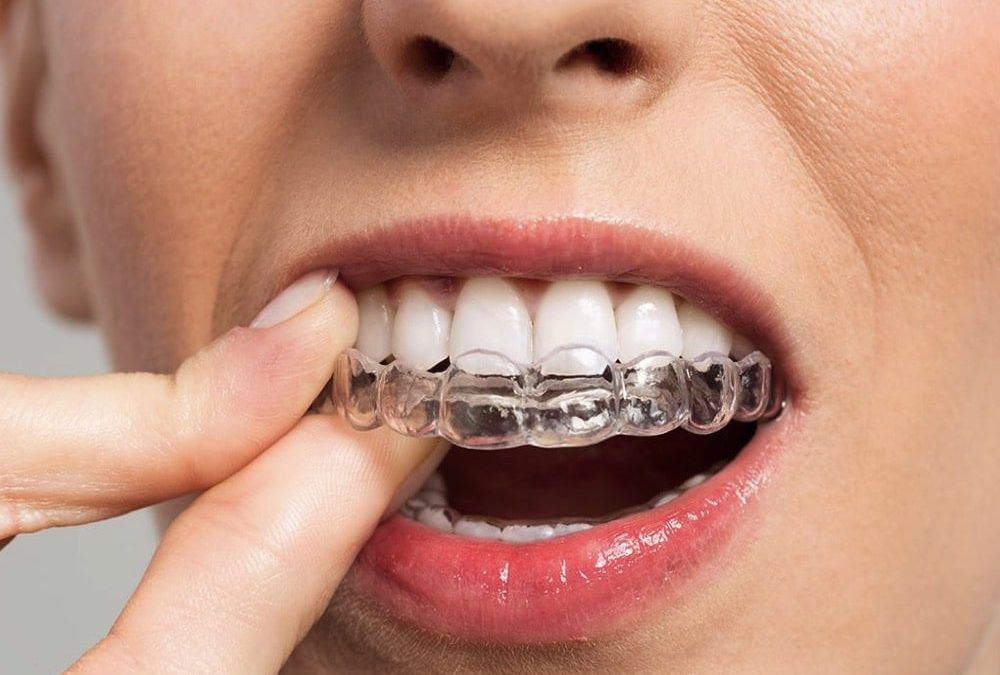 Invisalign en Fuenlabrada