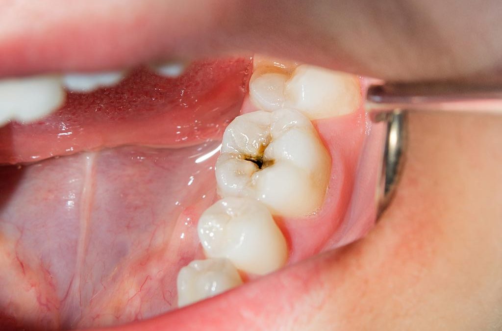 endodoncia