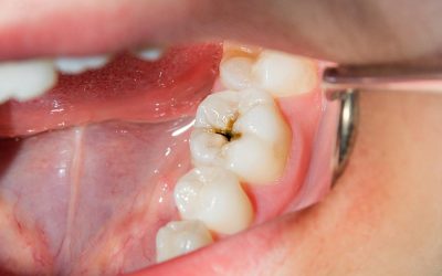 Cuándo es necesario una endodoncia