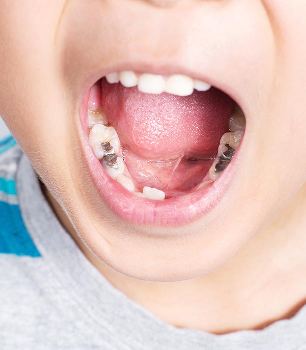 caries en niños