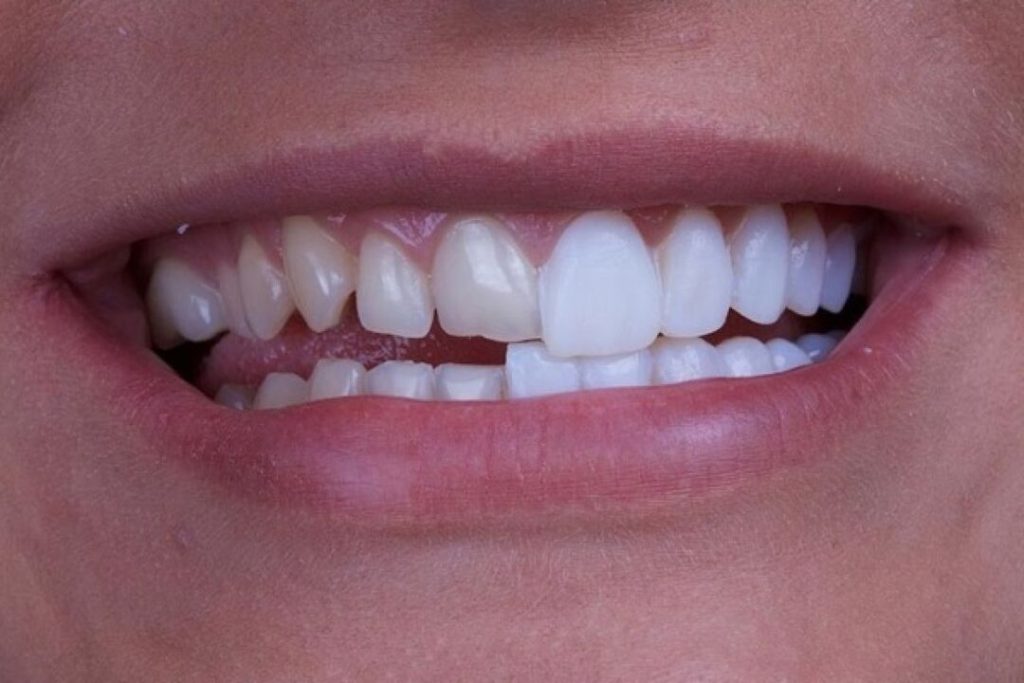 Carillas dentales en Móstoles