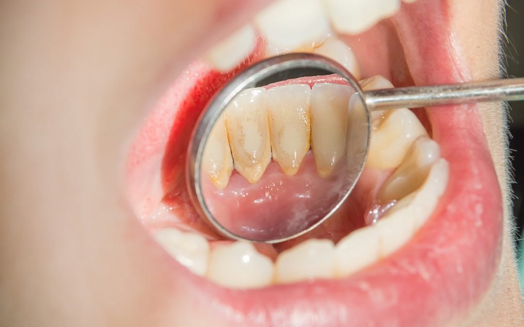quitar el sarro de los dientes