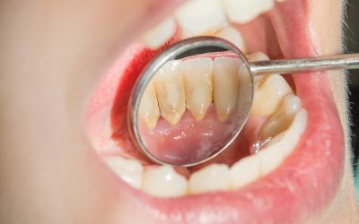 Cómo quitar el sarro de los dientes