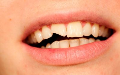 Reconstrucción dental en Móstoles