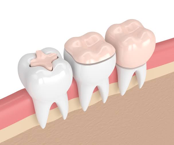 Reconstrucción dental en Fuenlabrada