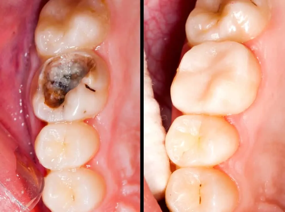reconstrucción dental en Móstoles