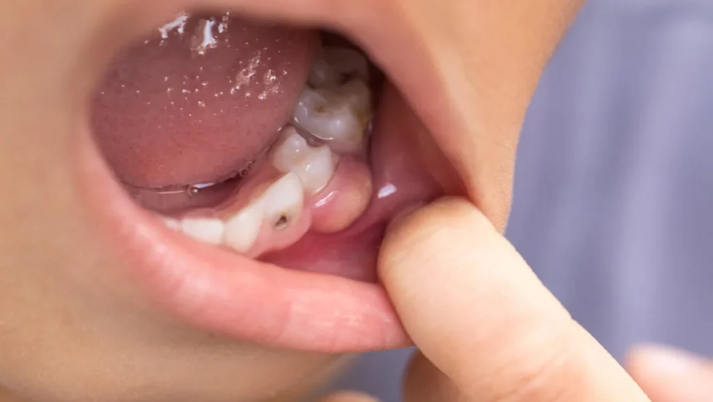 infección dental