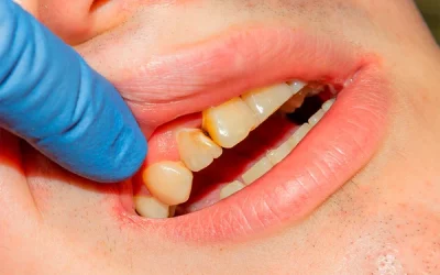 Cómo detectar caries a tiempo: guía completa para salvar tus dientes